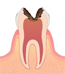 C3:歯髄まで進行
