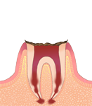 C4:歯髄が炎症