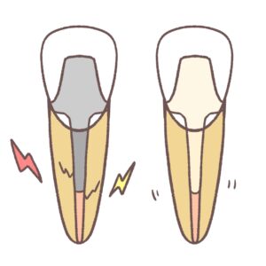 金属コアとファイバーコア